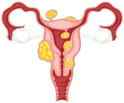 PCOD (Polycystic Ovary Disease)